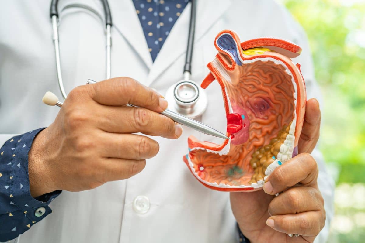 Dokter membawa model kanker perut di lambung
