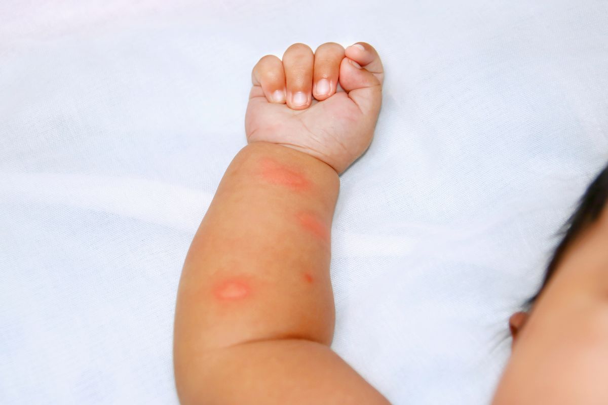 Close up tangan anak bayi yang memerah karena luka