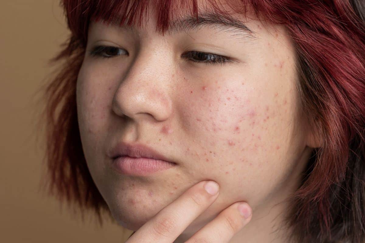 wajah yang breakout