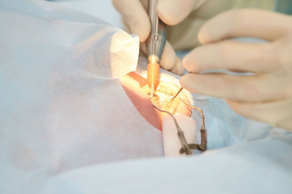 Dokter melakukan lasik