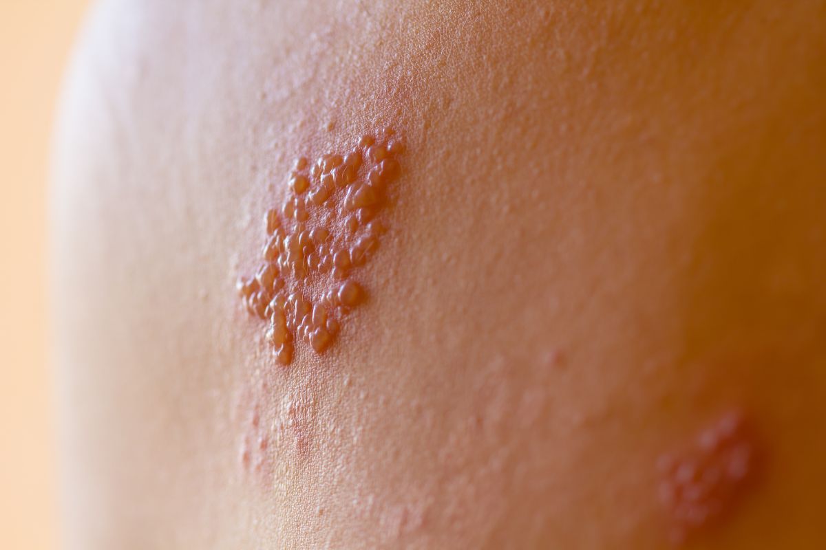Luka melepuh akibat herpes genital di kulit