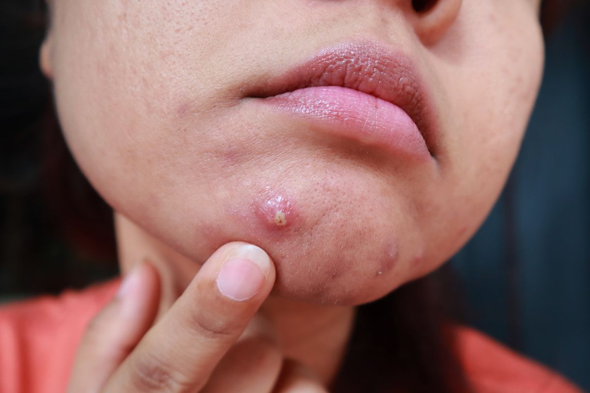 Seorang wanita dengan jerawat besar di dagu