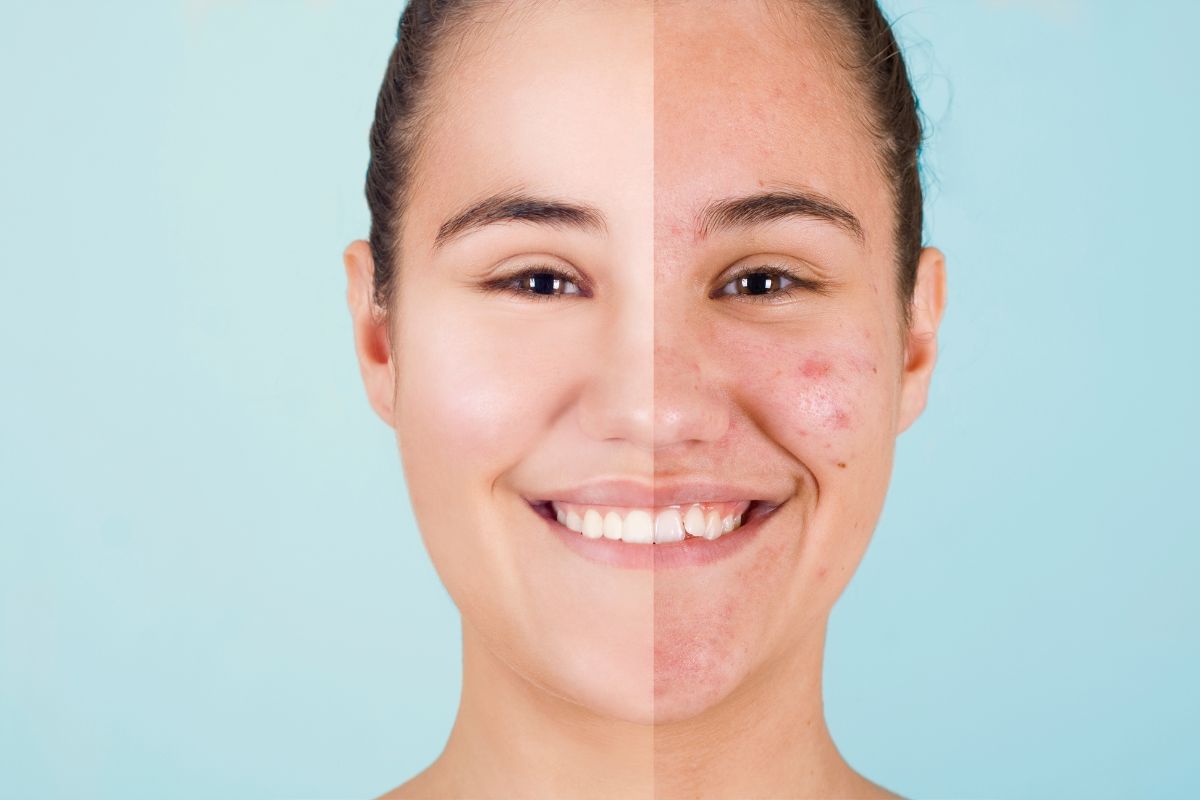 perbandingan muka jerawat sebelum dan sesudah