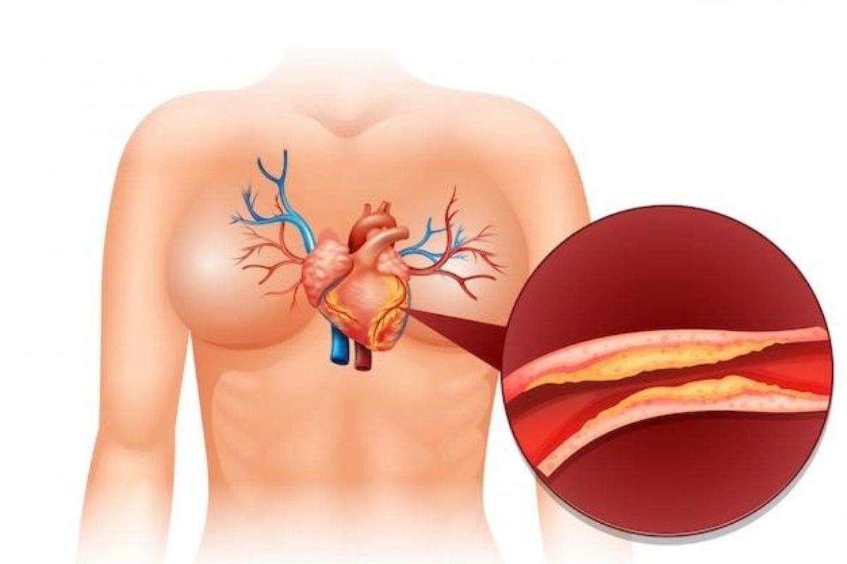 arteri yang tersumbat