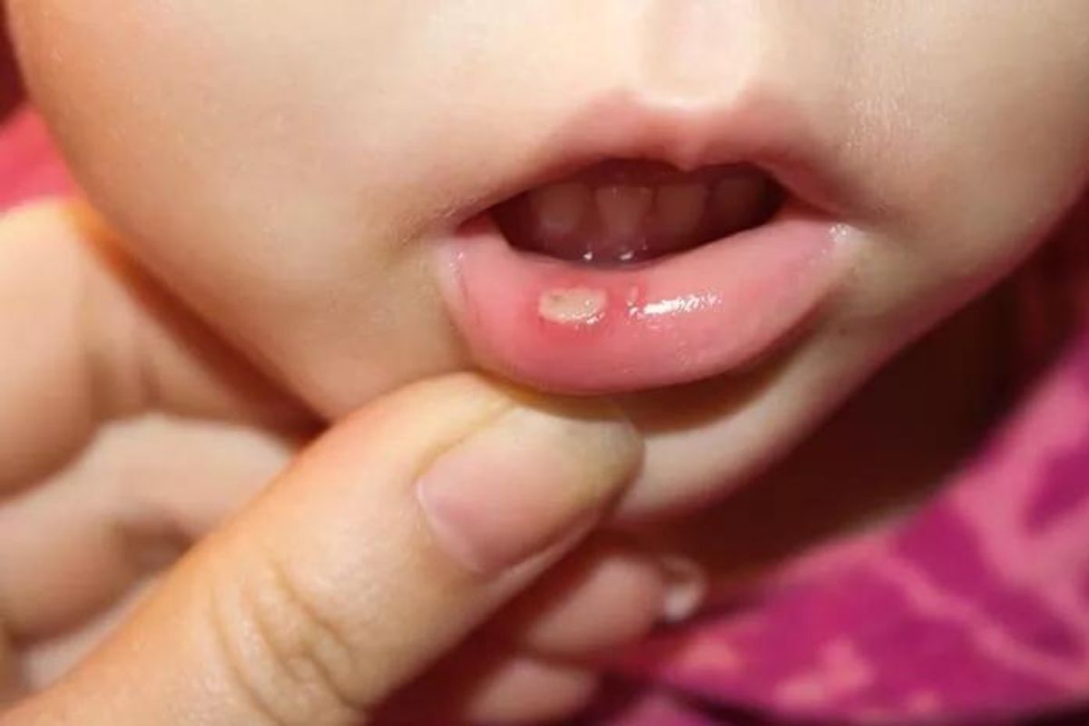 orang yang menunjukkan sariawan di bibir